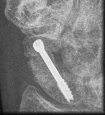 Scaphoid Nonunion Iliac crest Bone Graft